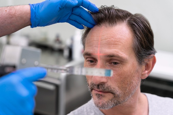 Médico tricólogo realizando un diagnóstico del cuero cabelludo de un hombre con alopecia para determinar las causas de la caída del pelo