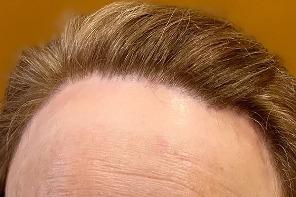 alopecia frontal fibrosante
