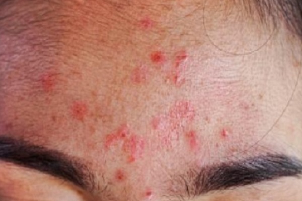 alopecia frontal fibrosante