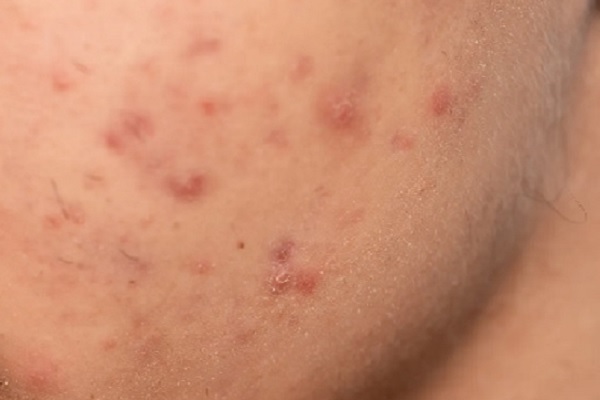 alopecia frontal fibrosante