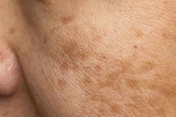 alopecia frontal fibrosante
