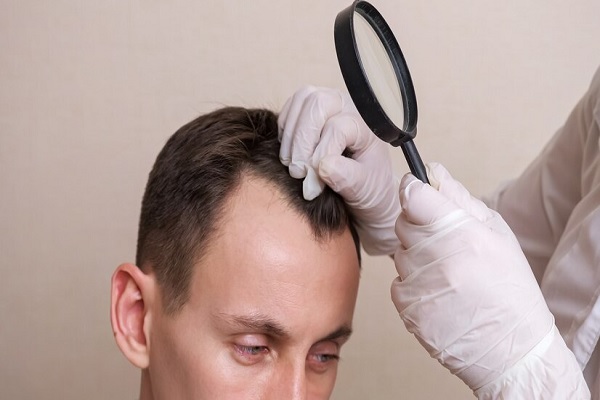 alopecia frontal fibrosante