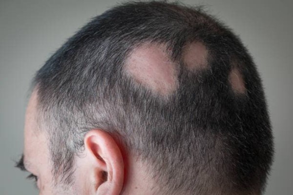 consejos para personas con alopecia areata