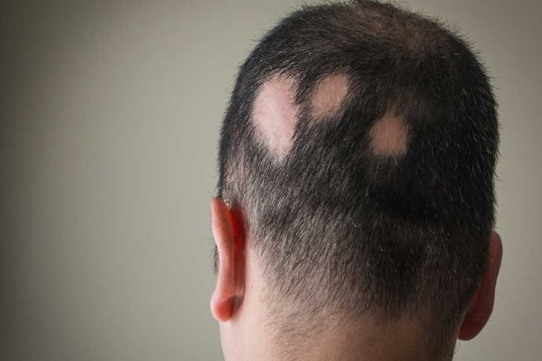 consejos para personas con alopecia areata