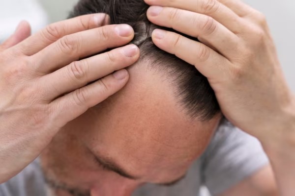 Caída del pelo en primavera