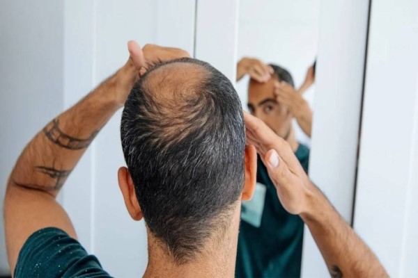 Minoxidil pastillas y Finasteride