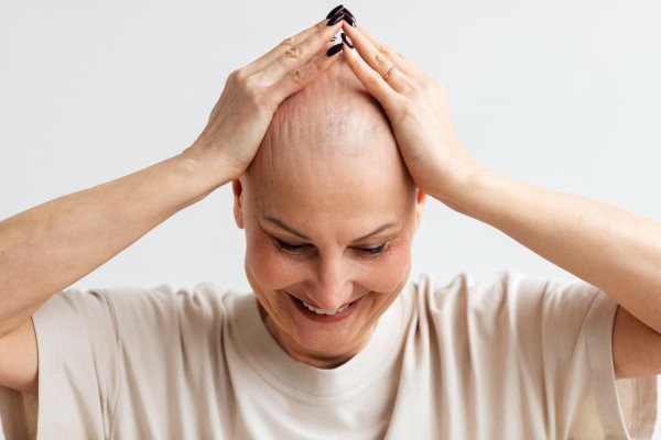 Alopecia en mujeres - mujer con alopecia causada por tratamiento medico