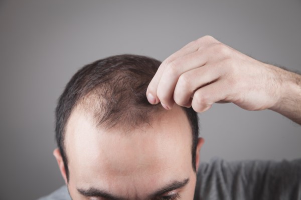 consecuencias de la alopecia - Hombre caucásico revisando su cabello. Problema de alopecia
