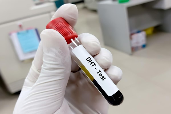 muestra para realizar la prueba de la dihidrotestosterona