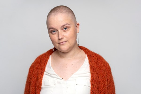 Alopecia en mujeres - mujer con problemas graves de alopecia