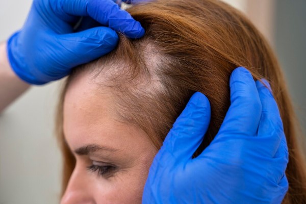 consecuencias de la alopecia - Mujer recibiendo un tratamiento de pérdida de cabello en una clínica