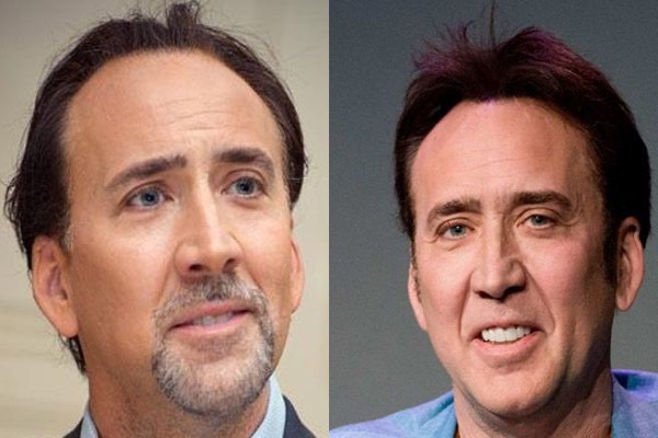 injerto capilar es más popular - Nicolas Cage