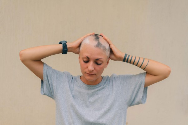 Alopecia en mujeres - alopecia difusa