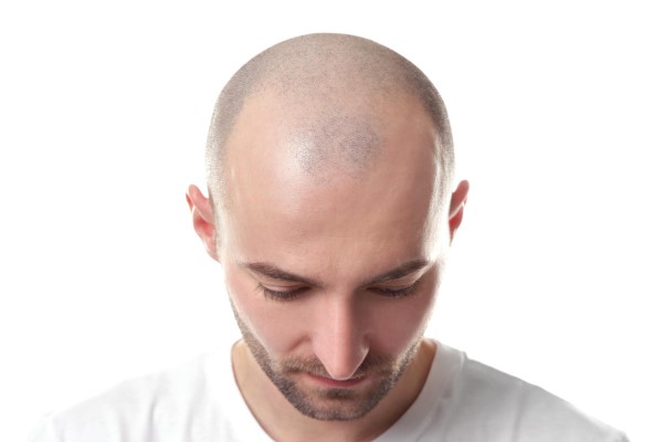 La calvicie en cifras -hombre joven con problemas de alopecia androgénica