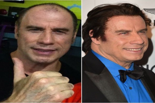 injerto capilar es más popular - John Travolta