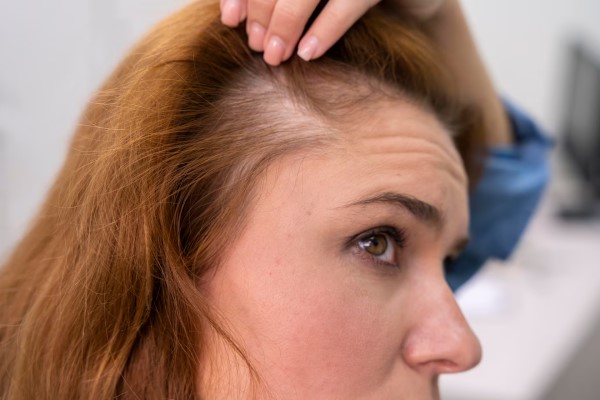 mujer que sufre alopecia androgénica