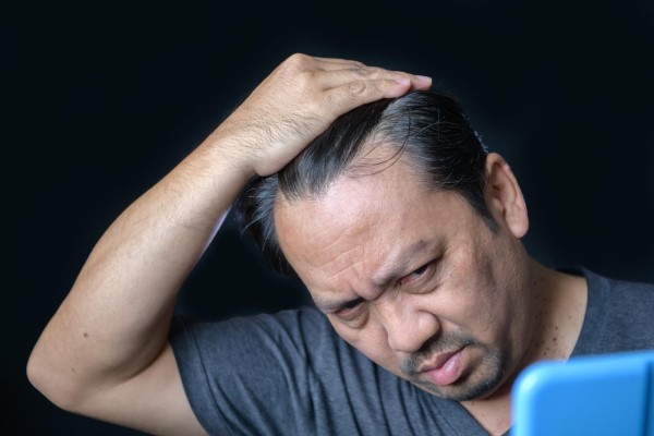 La calvicie en cifras - hombre asiático con problemas de alopecia