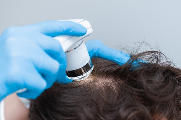 tricoscopia para diagnosticar problemas capilares