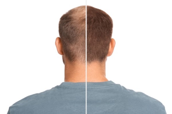 imagen del antes y después de la parte trasera de la cabeza de un hombre blanco tras someterse a un injerto capilar