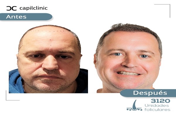  imagen de paciente de capilclinic antes y después del procedimiento de injerto capilar