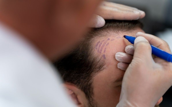 tricólogo en la consulta dibujando las líneas de injerto capilar para recuperar la línea frontal del paciente