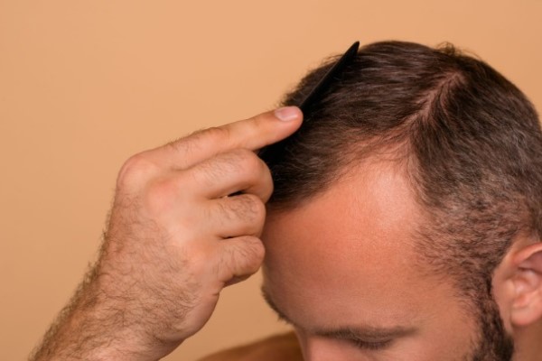 imagen de un hombre blanco peinándose el cabello con un peine después de recuperar su cabello con un injerto capilar