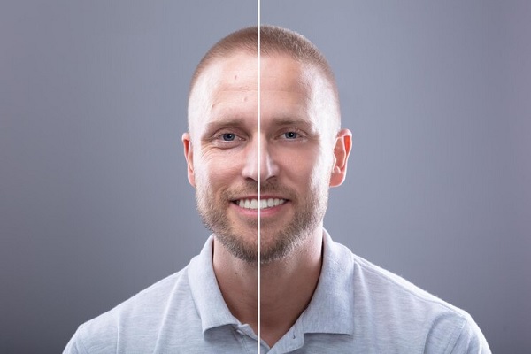 Beneficios psicológicos del trasplante capilar- antes y despues donde se aprecia el aspecto fisico que cambia un injerto de cabello