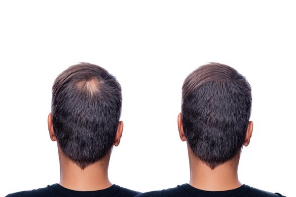 Beneficios del implante de cabello