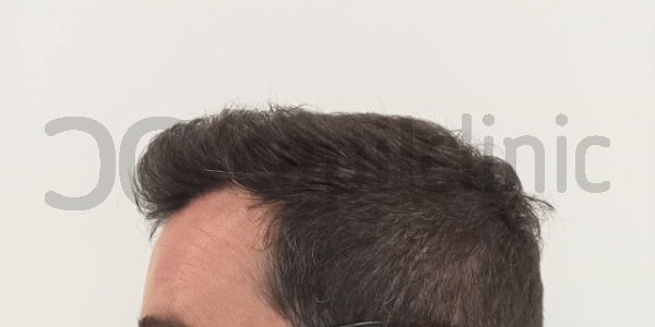 implante de pelo 6 meses tras operación
