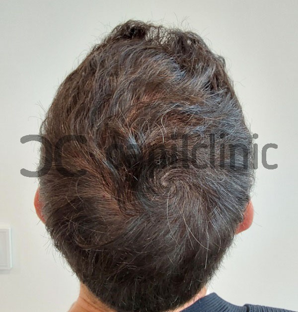 muestra de como evoluciona el implante de cabello 10 meses despúes