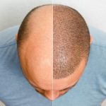 Cómo es el proceso del trasplante capilar proceso del trasplante capilar - El mejor tratamiento para la pérdida de cabello en hombres