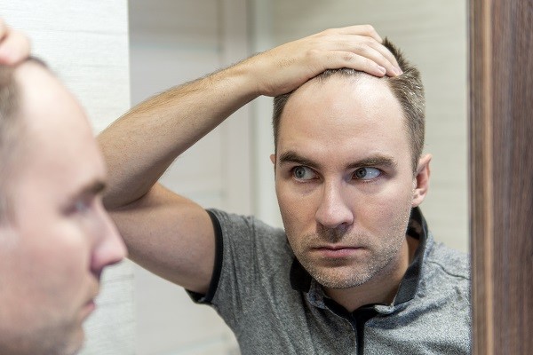 Alopecia androgénica - hombre caucásico delante del espejo comprobando las entradas de su cabello