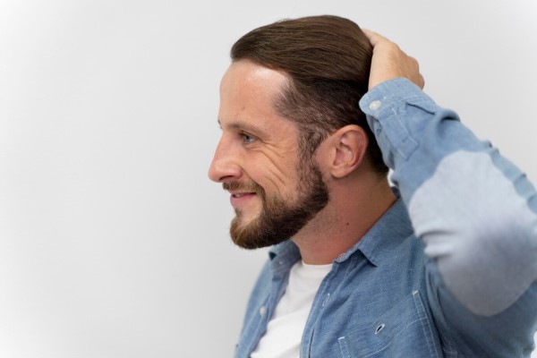 peinar el pelo después del trasplante capilar - hombre adulto ayudándose de su mano para peinar con mucho cuidado su cabello