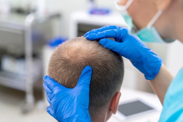 hombre con problemas de alopecia en la consulta del especialista