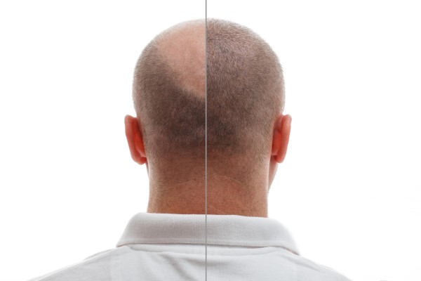 La cabeza de un hombre calvo antes y después de la cirugía de trasplante de cabello
