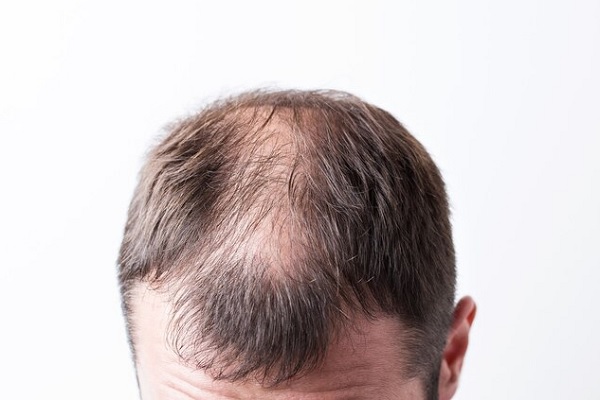 cae el pelo- Hombre con claros indicios de alopecia