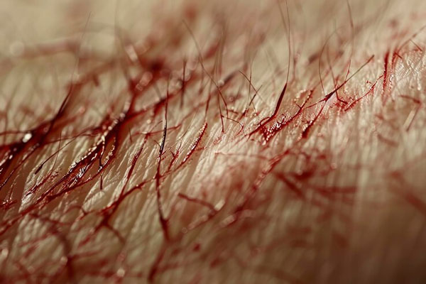 Plano detalle de un ligero sangrado en el cuero cabelludo tras trasplante de cabello