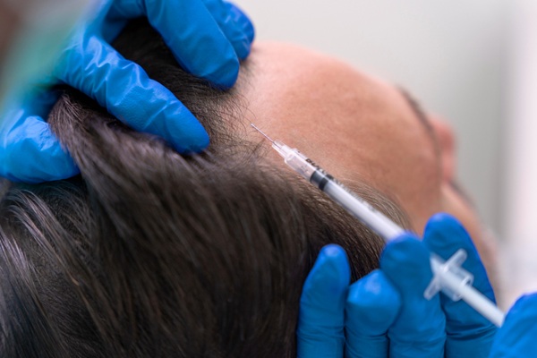 Implante capilar células madre - Médico especialista realizando un injerto capilar Colombia a un hombre con pérdida de cabello en las entradas