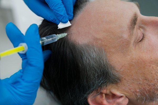 Injerto de cabello costo - Tricólogo realizando un trasplante capilar a un hombre con pérdida de cabello en las entradas