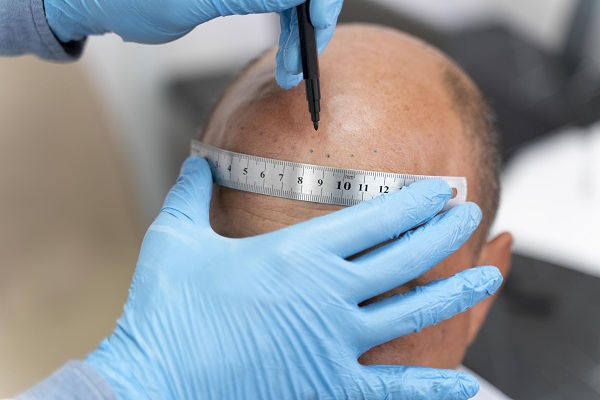 Injerto de cabello en Colombia - tricólogo realizando el diseño de un injerto de cabello