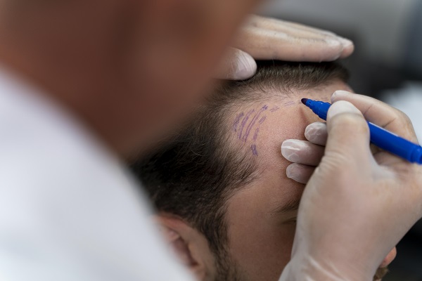 Injerto de cabello en Colombia - Cirujano capilar dibujando el diseño de un trasplante capilar en la zona de las entradas de un paciente