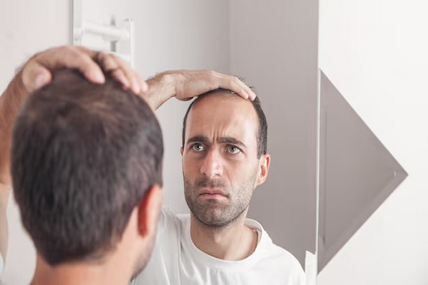 Hombre mirando en el espejo el avance de la alopecia en su cabeza