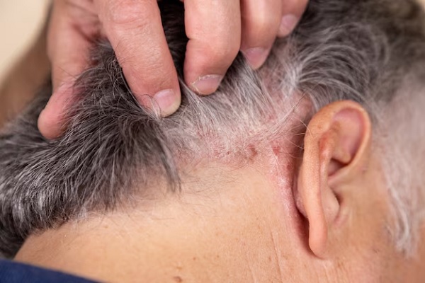 Tratamiento de dermatitis seborreica - hombre muestra la inflamación en su cabello