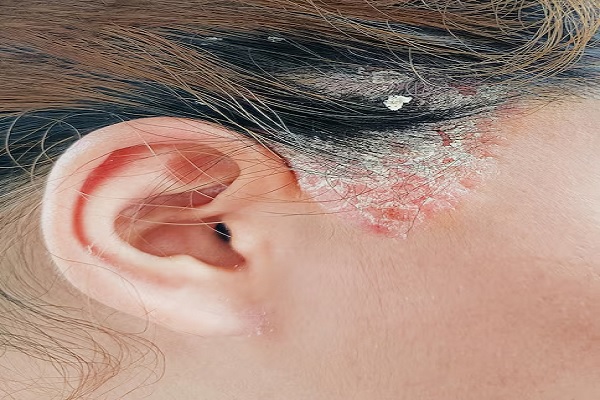 Tratamiento de dermatitis seborreica - mujer con muestras de un problema en la piel del cuero cabelludo
