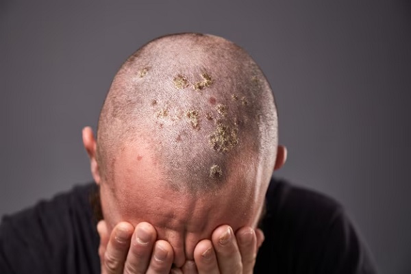 tratamiento de dermatitis seborreica - hombre mostrando como se extiende el hongo