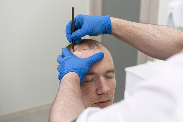 Cuánto cuesta un implante de cabello - el especialista marca la zona de las entradas a hombre con una pronunciada calvicie