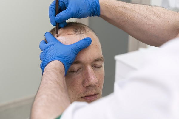 etapas del implante capilar, la linea del cabello es marcada por un especialista a paciente hombre con calvicie