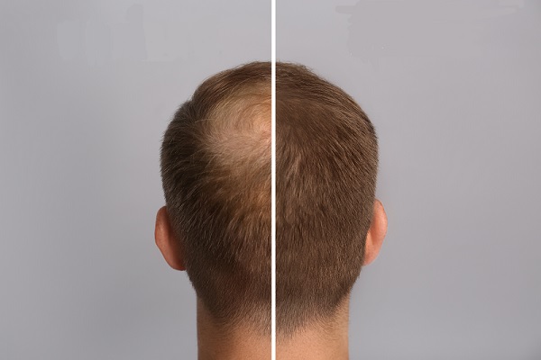 injerto de cabello antes y después, la parte posterior de un hombre, en un lado se muestra un hombre con alopecia y el otro lado el hombre luego del injerto capilar