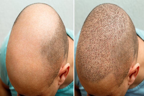 injerto de cabello antes y después, hombre muestra el proceso de implante capilar, en parte frontal de la cabeza