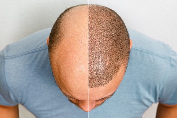 injerto de cabello antes y después, vista superior de la cabeza de un hombre dividida en dos mitades: a la izquierda se observa una zona calva con pérdida significativa de cabello, mientras que a la derecha aparece con mayor densidad capilar, por posible resultado de un tratamiento de restauración como un trasplante capilar